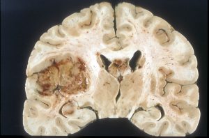 Glioblastoma