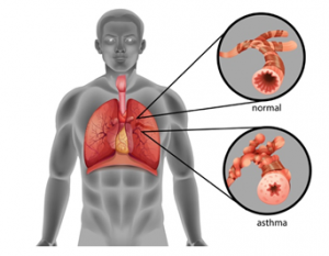 diagram showing asthma in lungs