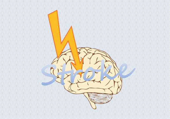 stroke