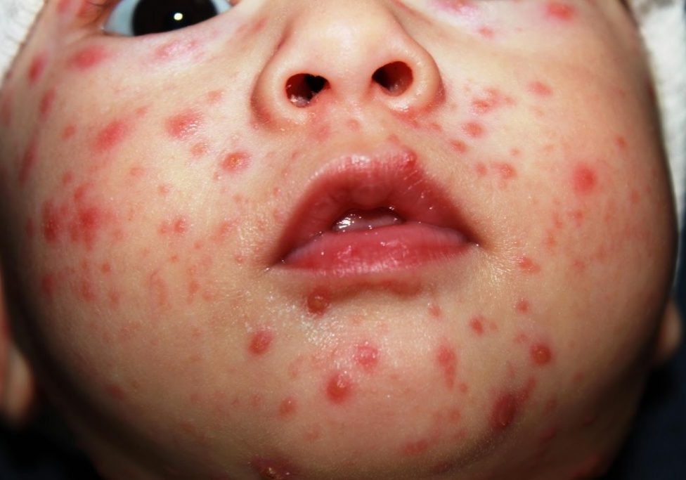 chicken pox